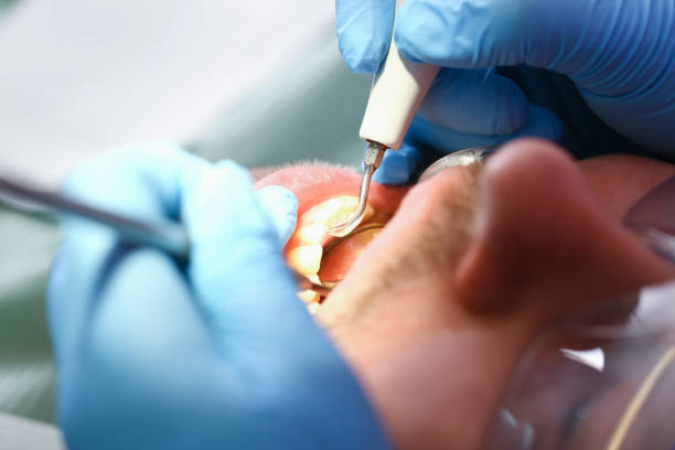 Best Emergency Dentist for Knocked-Out Tooth in City View, SC